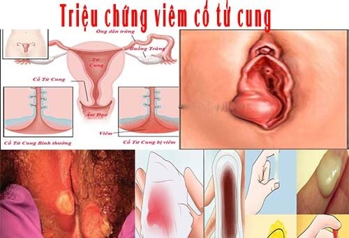 Triệu chứng viêm cổ tử cung 